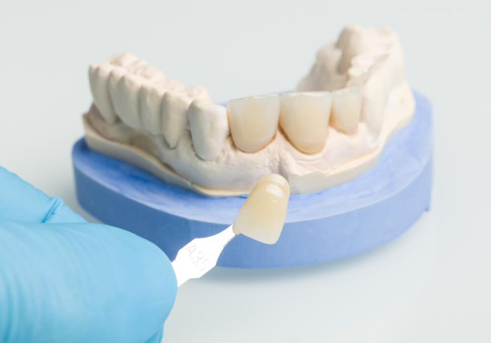 Dental Crowns